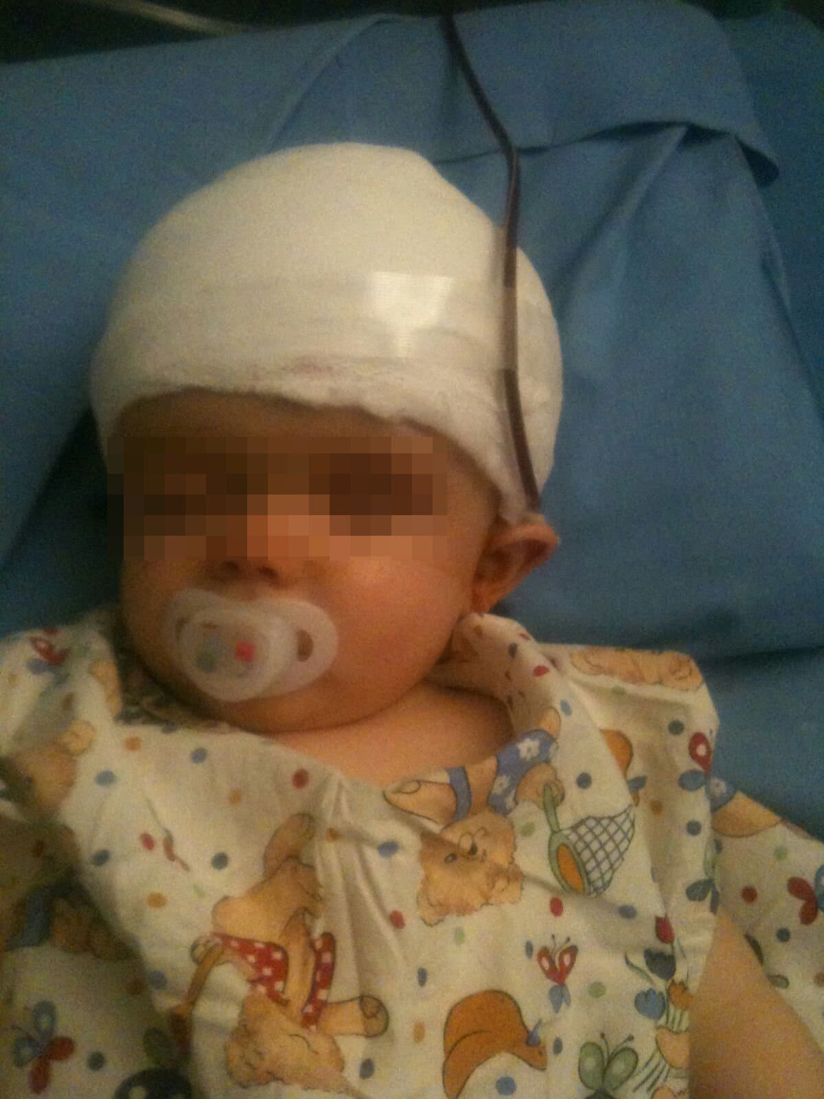 Un piccolo paziente dopo l'operazione Craniostenosi, Istituto Besta Milano, bimbo in ospedale