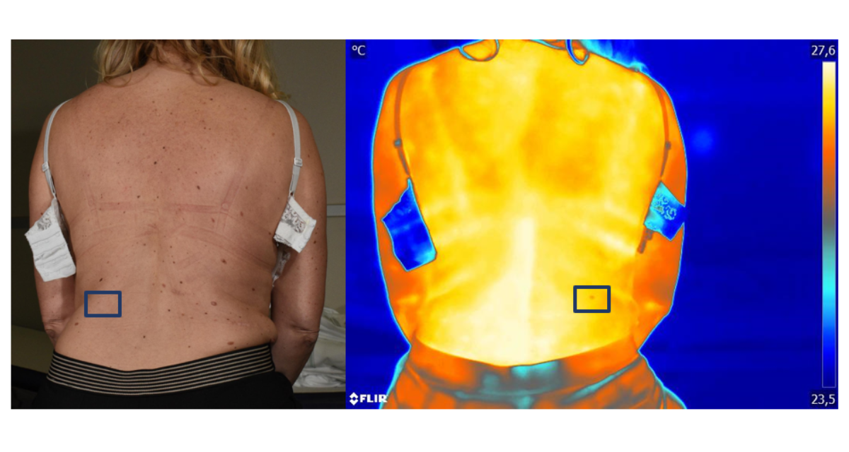 La prevenzione del melanoma corre con Te di Associazione Piccoli Punti La prevenzione del melanoma corre con Te-Associazione Piccoli Punti