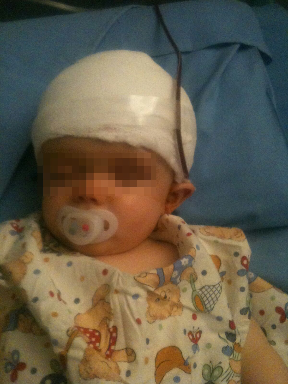 Craniostenosi, Istituto Besta Milano, bimbo in ospedale