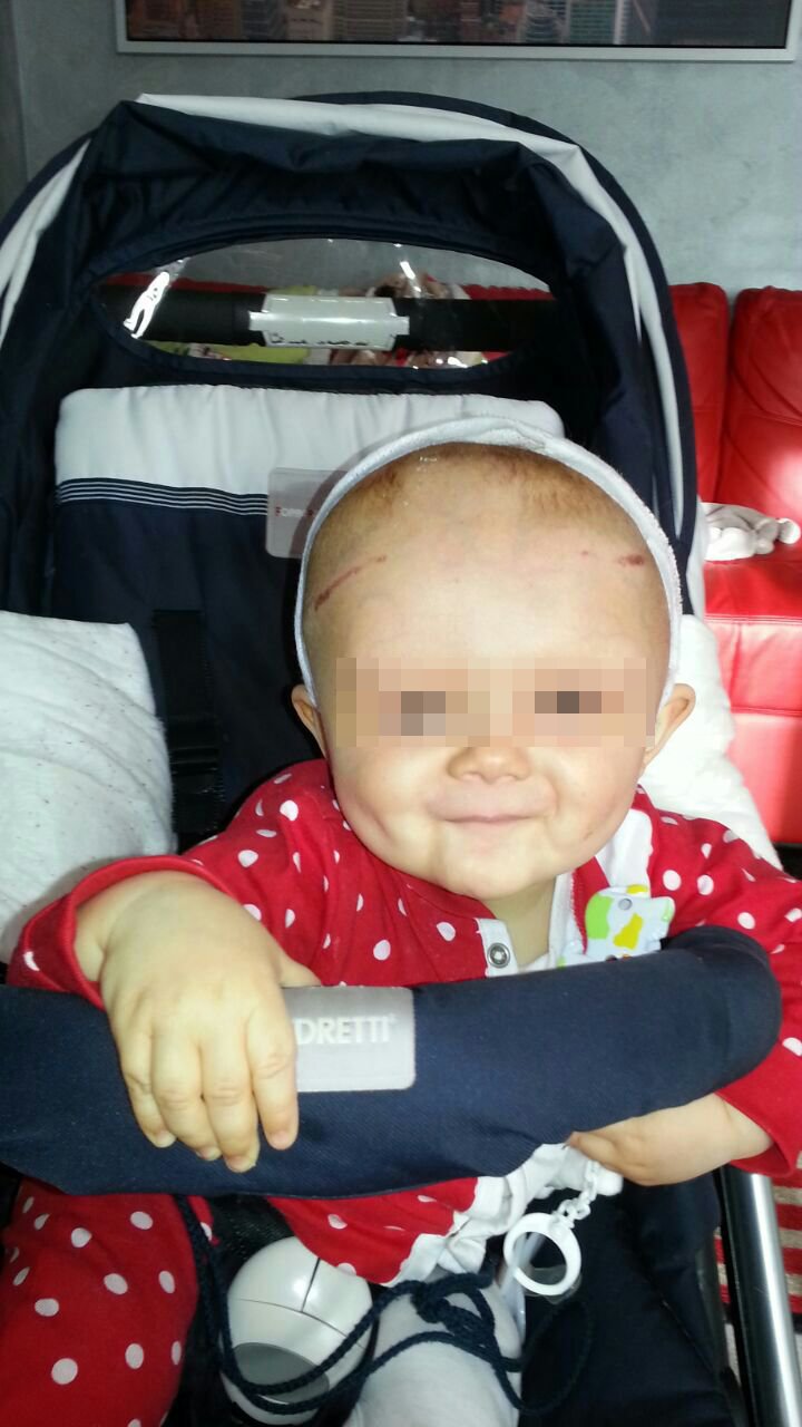 Craniostenosi, bimbo dopo intervento