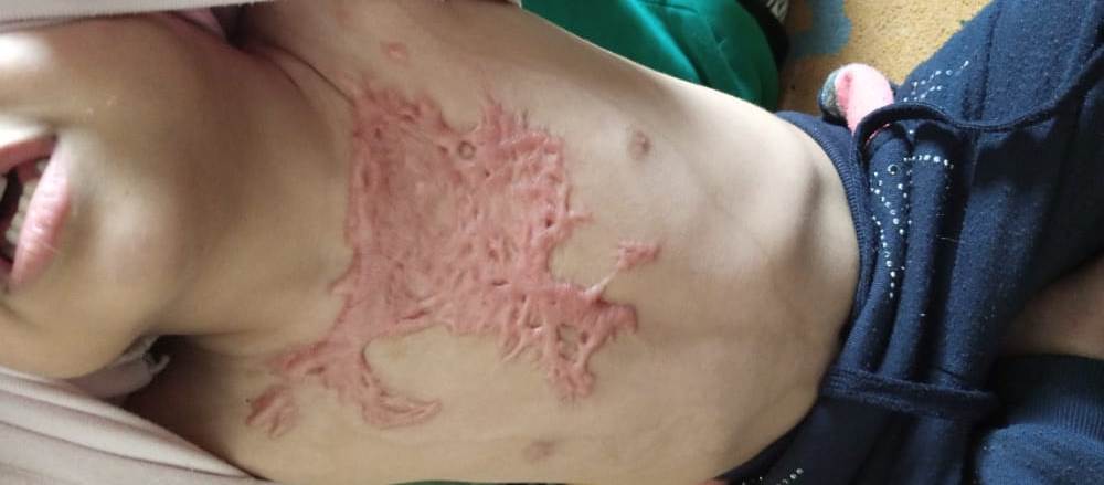 LA PICCOLA HANEEN VUOLE SORRIDERE-GLOBAL HUMANITARIA