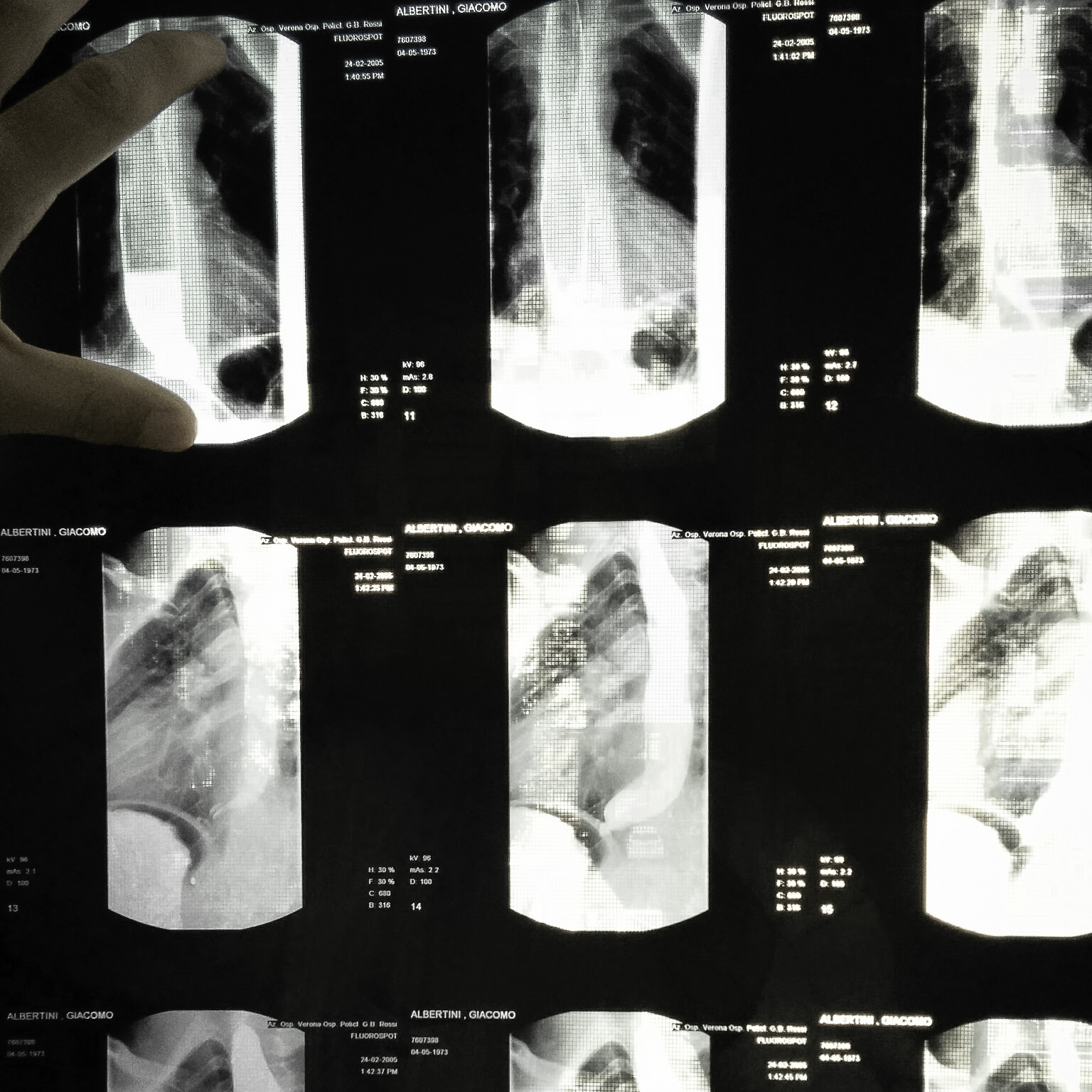 Parliamo di acalasia esofagea-ALMA ONLUS